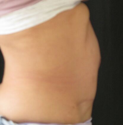 Fleur-de-Lys Abdominoplasty after massive weight loss: Case 1 - After