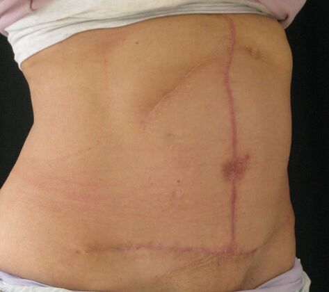 Fleur-de-Lys Abdominoplasty after massive weight loss: Case 1 - After