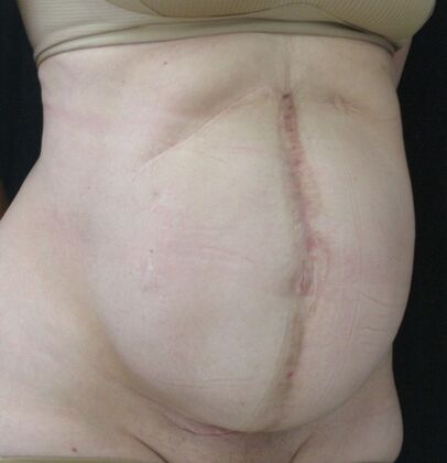 Fleur-de-Lys Abdominoplasty after massive weight loss: Case 1 - Before