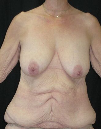 Fleur-de-Lys Abdominoplasty after massive weight loss Case 2 - Before