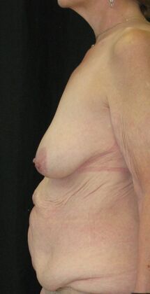 Fleur-de-Lys Abdominoplasty after massive weight loss: Case 2 - Before