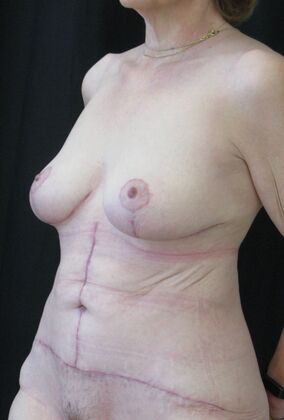 Fleur-de-Lys Abdominoplasty after massive weight loss: Case 2 - After