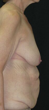 Fleur-de-Lys Abdominoplasty after massive weight loss: Case 2 - Before
