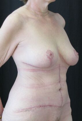Fleur-de-Lys Abdominoplasty after massive weight loss: Case 2 - After