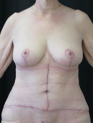 Fleur-de-Lys Abdominoplasty after massive weight loss Case 2 - After