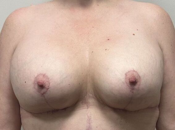 Breast Revision Case 370 - After
