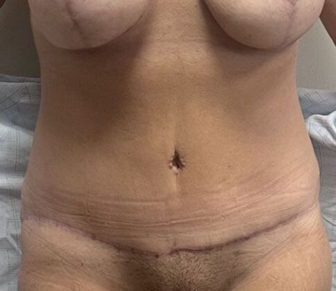 Tummy Tuck (Abdominoplasty): Case 8 - After