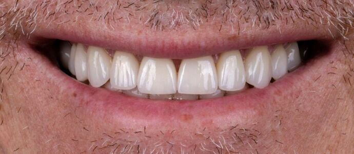 Smile Makeover & Veneers: Theo - After