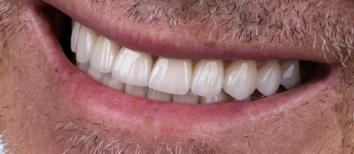 Smile Makeover & Veneers: Theo - After