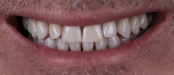 Smile Makeover & Veneers: Theo - Before