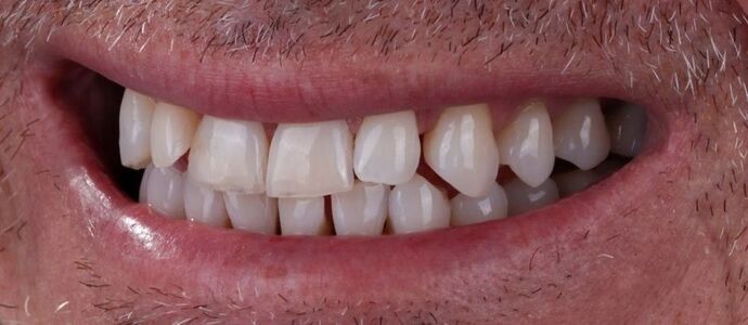 Smile Makeover & Veneers: Theo - Before