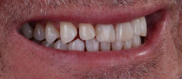 Smile Makeover & Veneers: Theo - Before