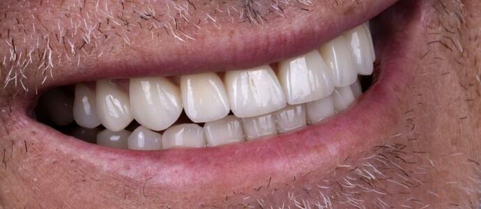 Smile Makeover & Veneers: Theo - After