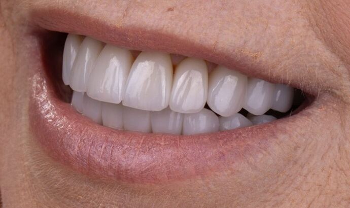 Smile Makeover & Veneers: Claudia - After