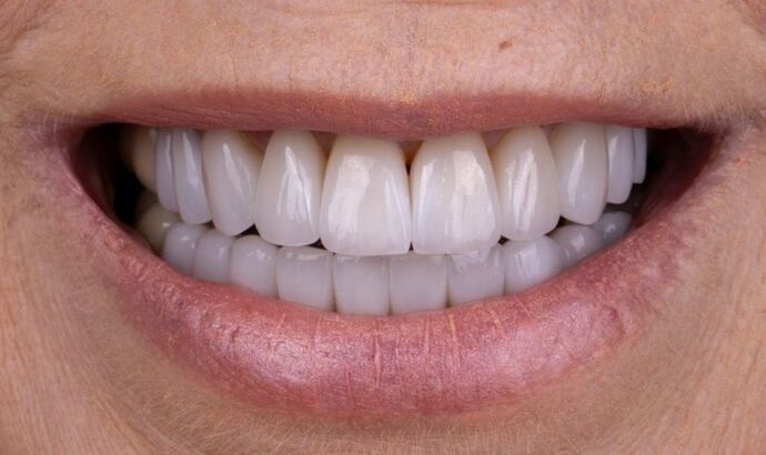 Smile Makeover & Veneers: Claudia - After