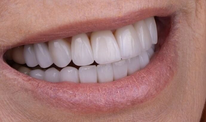 Smile Makeover & Veneers: Claudia - After