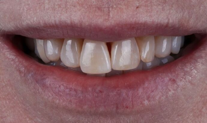 Smile Makeover & Veneers: Claudia - Before