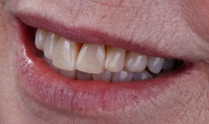 Smile Makeover & Veneers: Claudia - Before