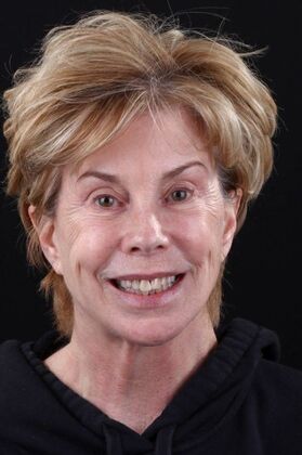 Smile Makeover & Veneers: Claudia - Before