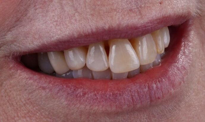 Smile Makeover & Veneers: Claudia - Before