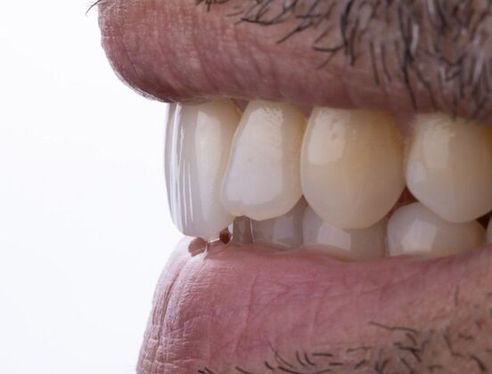 Smile Makeover & Veneers: Rowan - After
