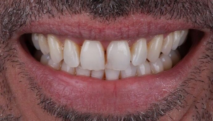 Smile Makeover & Veneers: Rowan - Before