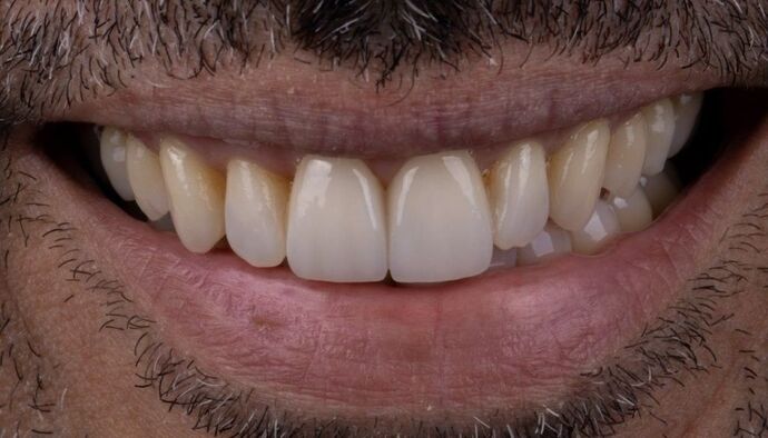 Smile Makeover & Veneers: Rowan - After