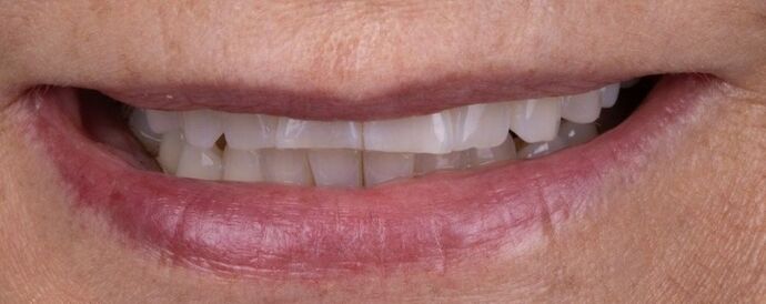 Smile Makeover & Veneers: Esme - Before