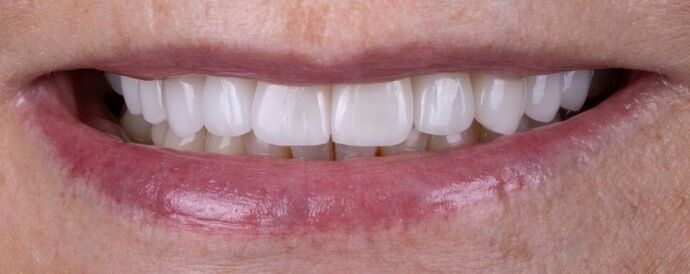 Smile Makeover & Veneers: Esme - After