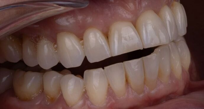Smile Makeover & Veneers: Esme - Before