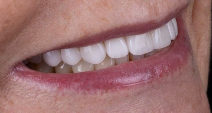Smile Makeover & Veneers: Esme - After