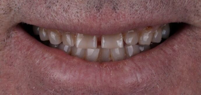 Smile Makeover & Veneers: Gareth - Before