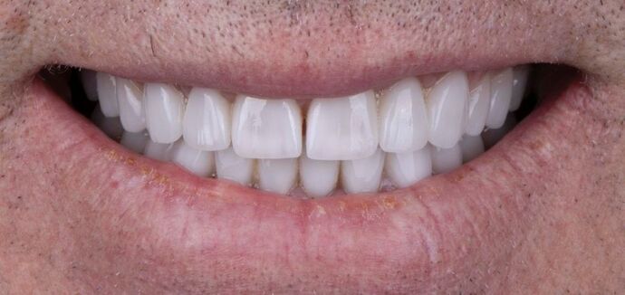 Smile Makeover & Veneers: Gareth - After