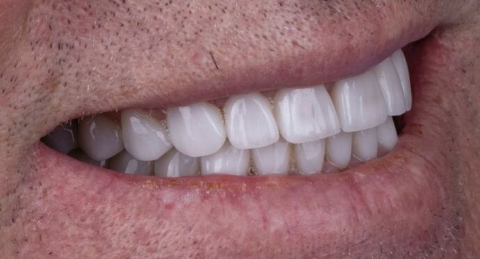 Smile Makeover & Veneers: Gareth - After
