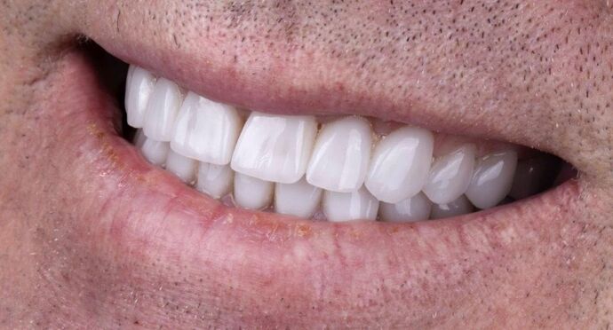 Smile Makeover & Veneers: Gareth - After