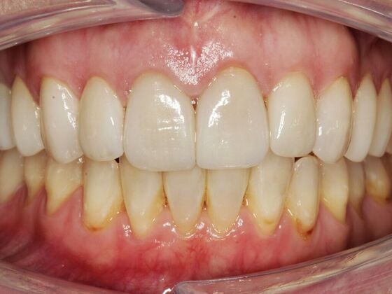 Full Mouth Rehabilitation Andrea  - After