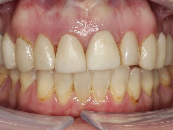 Full Mouth Rehabilitation Andrea  - Before