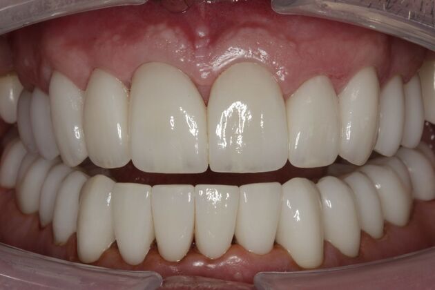 Full Mouth Rehabilitation Don  - After