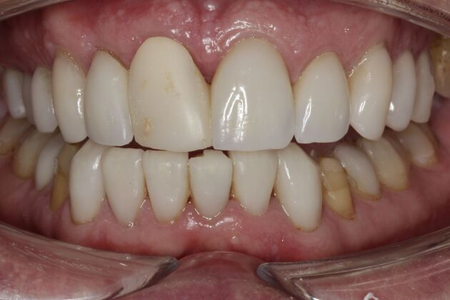 Full Mouth Rehabilitation Don  - Before