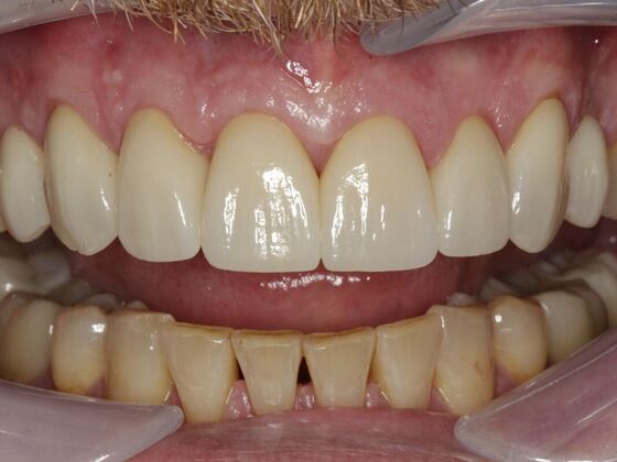Full Mouth Rehabilitation Doug - After