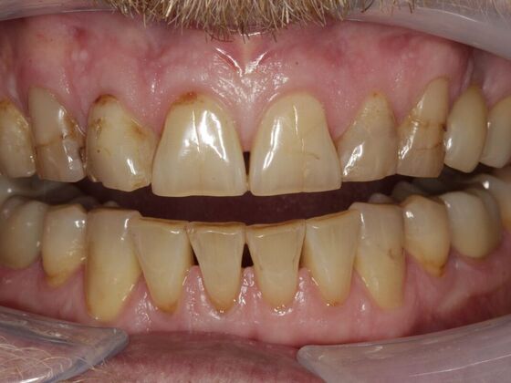 Full Mouth Rehabilitation Doug - Before