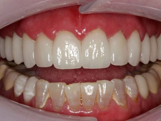Full Mouth Rehabilitation Elissa  - After
