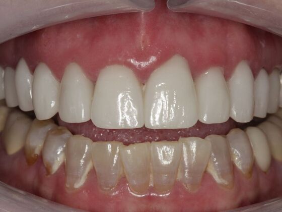 Full Mouth Rehabilitation Elissa  - Before