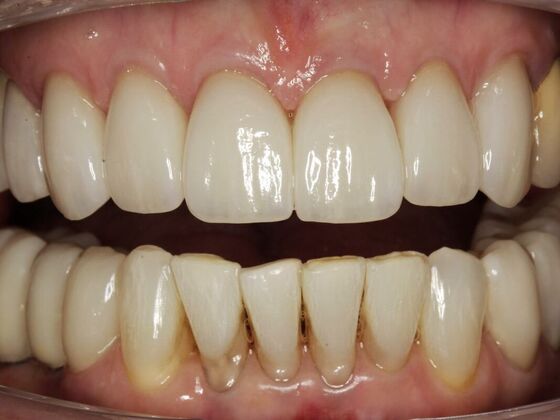 Full Mouth Rehabilitation Joyce - After