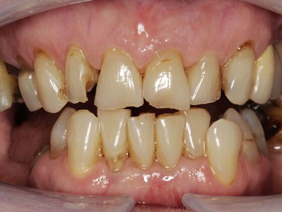 Full Mouth Rehabilitation Joyce - Before