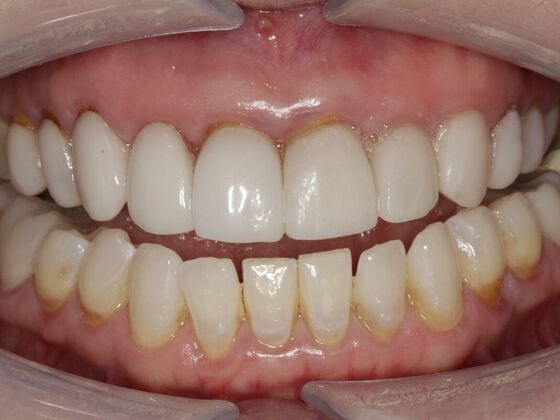 Full Mouth Rehabilitation Julie - Before