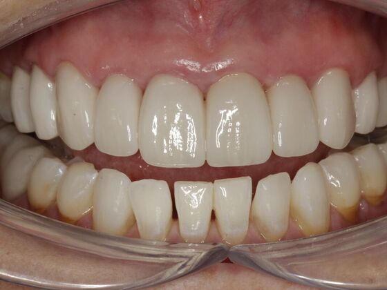 Full Mouth Rehabilitation Julie - After