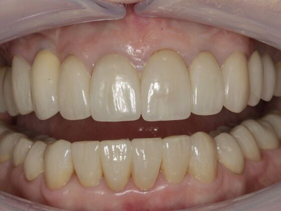 Full Mouth Rehabilitation Kat - After
