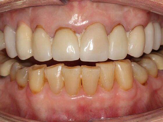 Full Mouth Rehabilitation Kat - Before