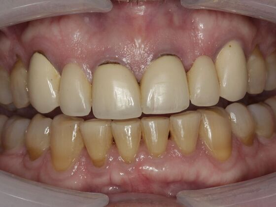 Full Mouth Rehabilitation Mike - Before